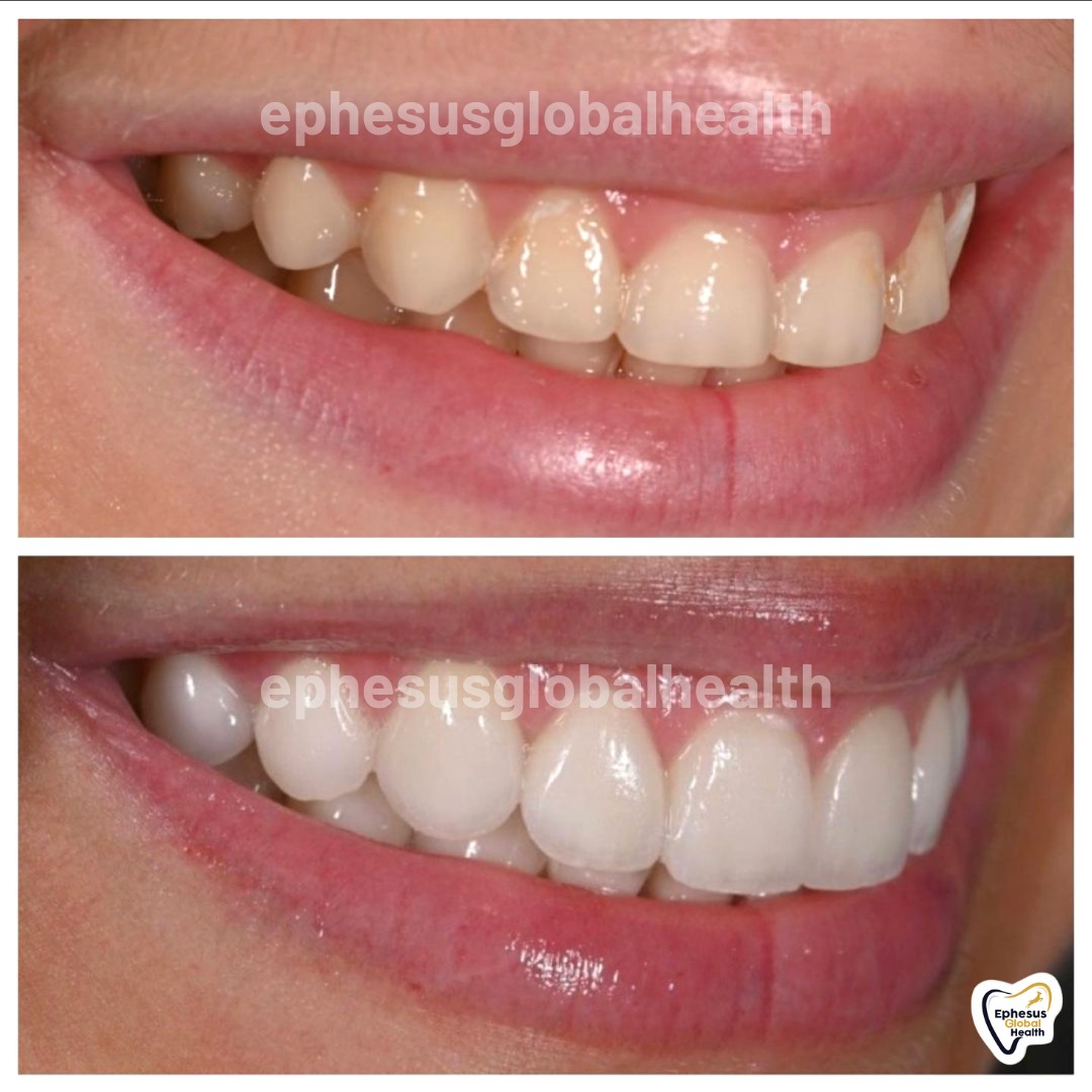 Couronnes Zircones — Ephesus global dental