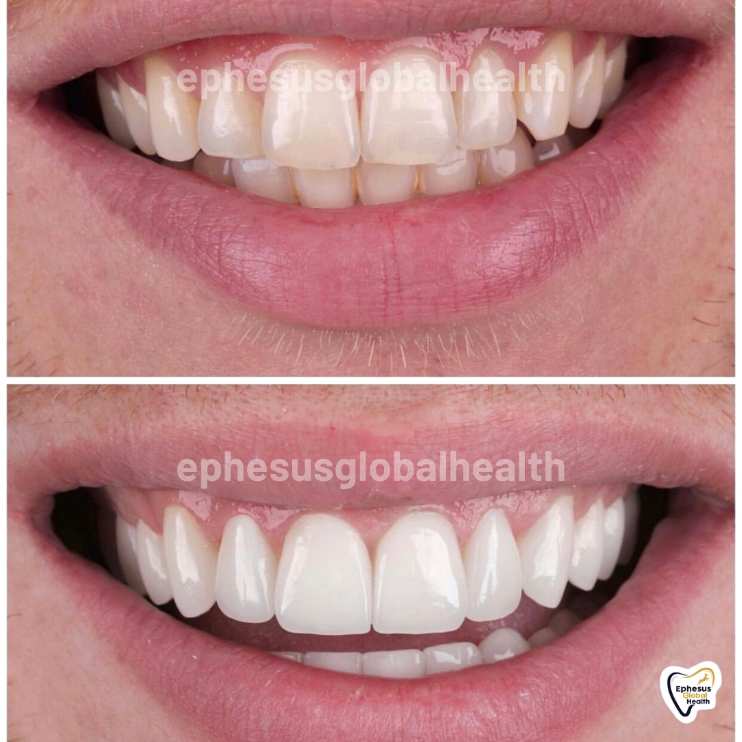 Couronnes Zircones — Ephesus global dental