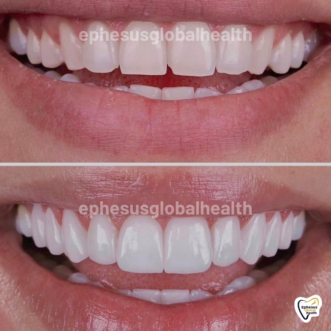 Couronnes Zircones — Ephesus global dental