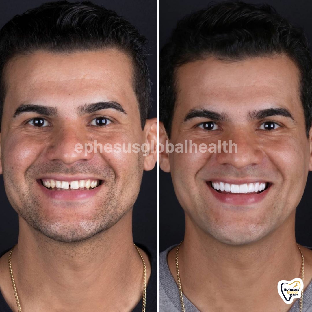 Couronnes Zircones — Ephesus global dental