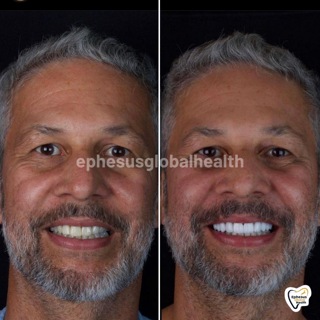 Couronnes Zircones — Ephesus global dental