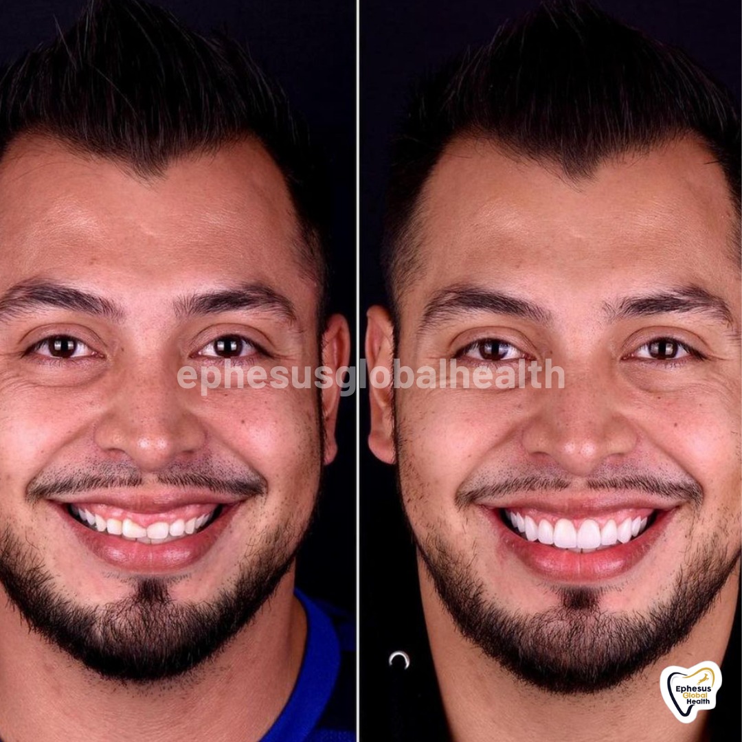 Couronnes Zircones — Ephesus global dental