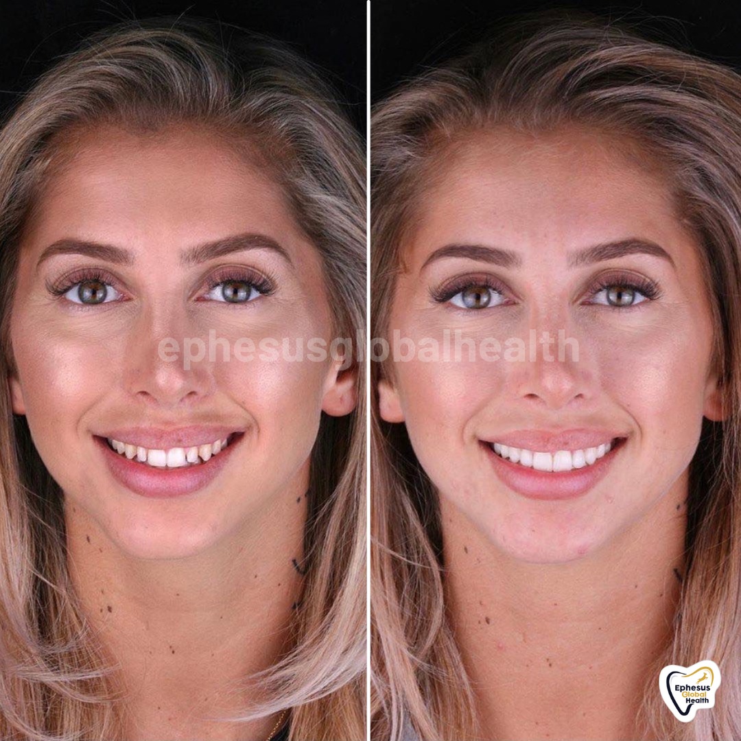 Couronnes Zircones — Ephesus global dental