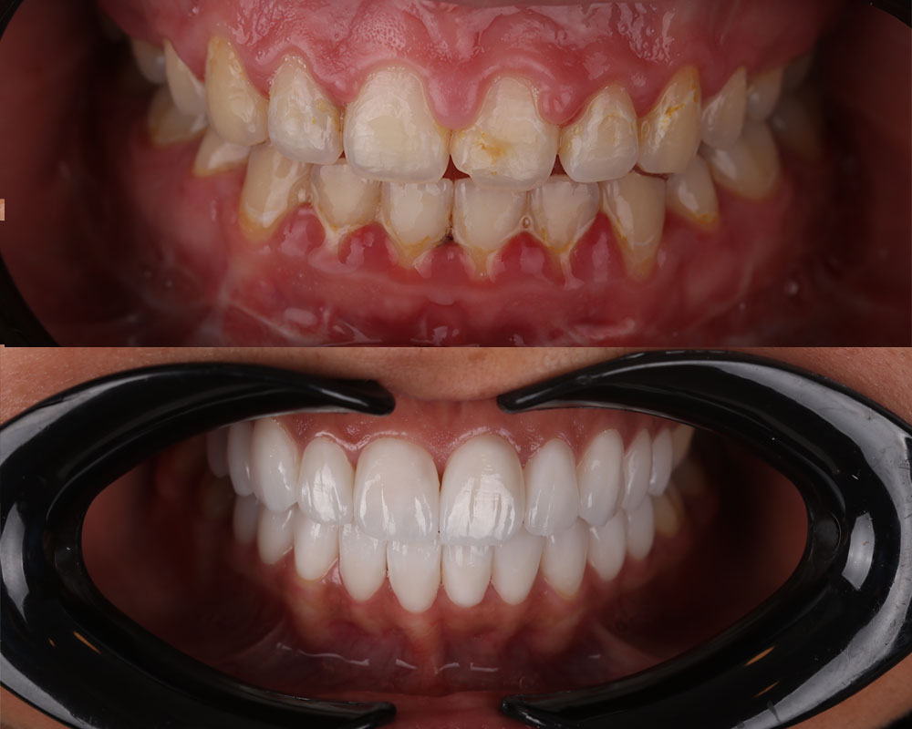 Facettes Dentaires — DXB Esthétique