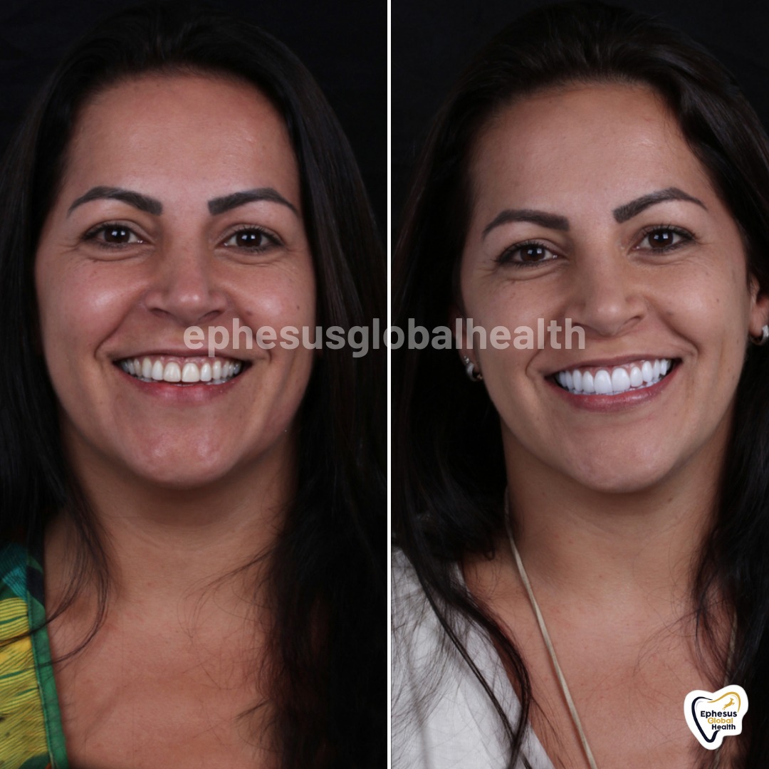 Couronnes Zircones — Ephesus global dental