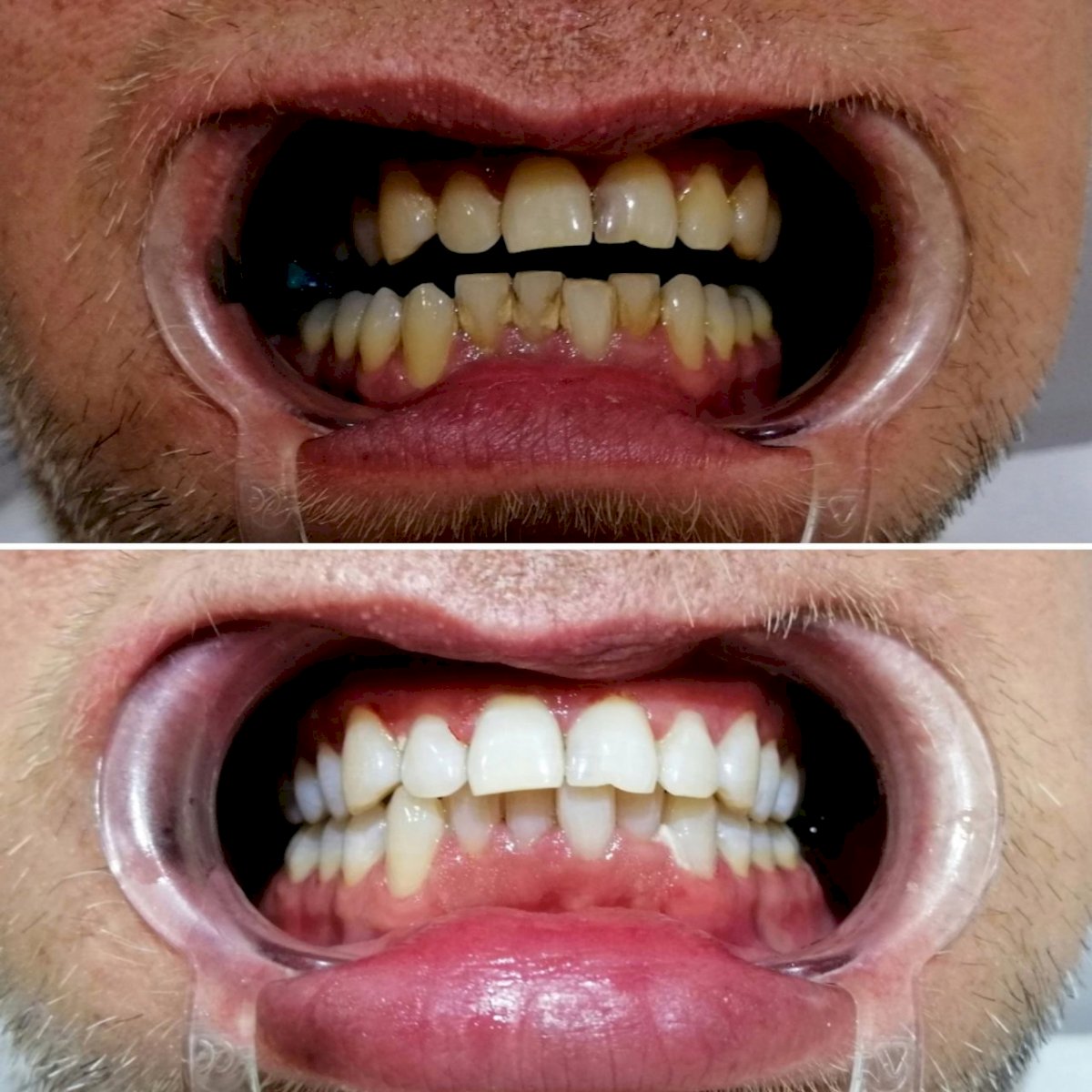 Couronnes Zircones — Ephesus global dental