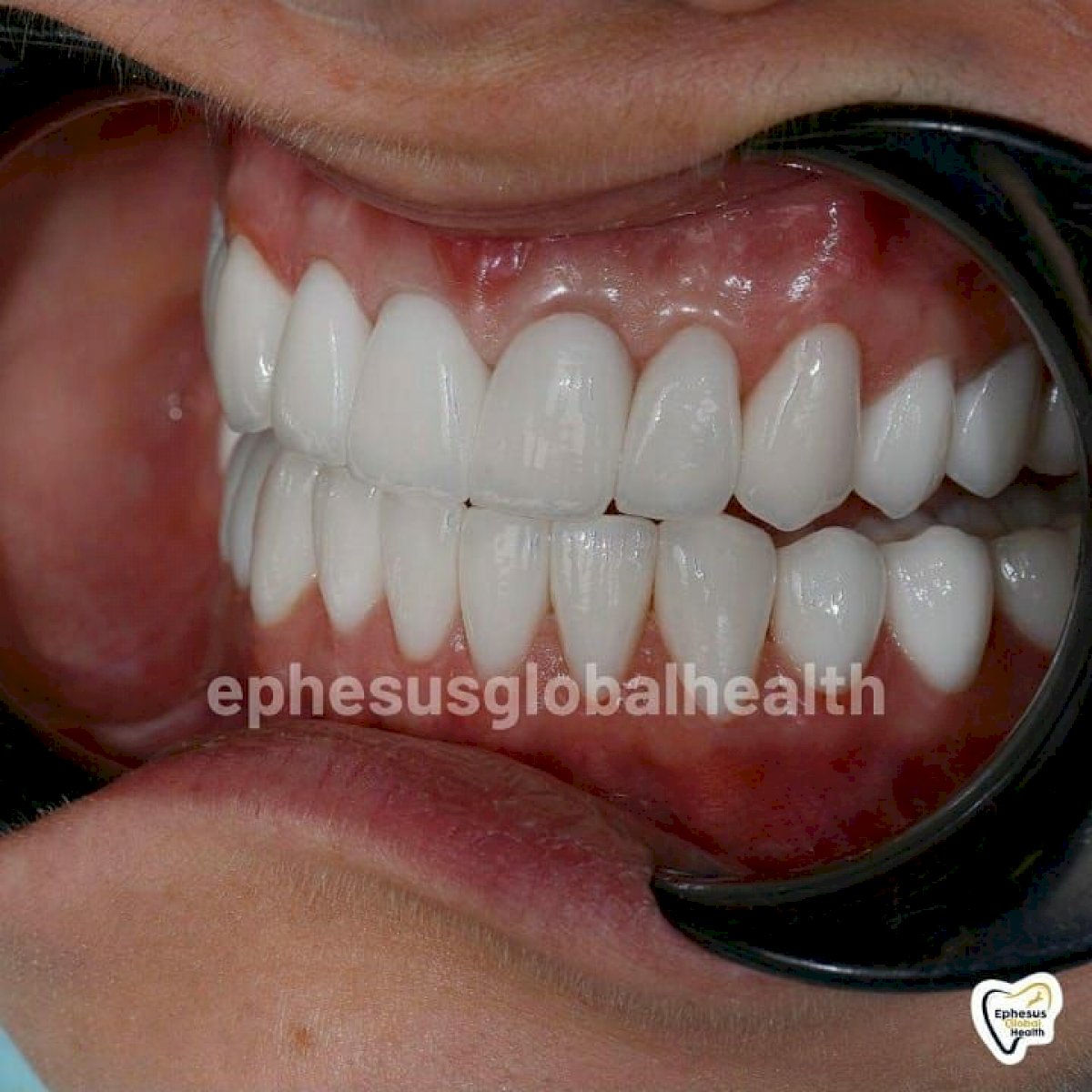 Couronnes Zircones — Ephesus global dental