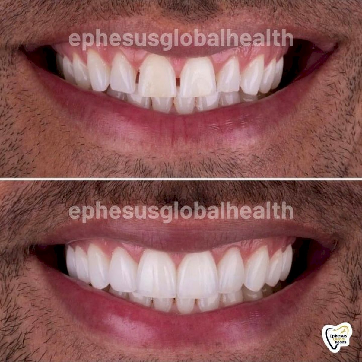 Couronnes Zircones — Ephesus global dental