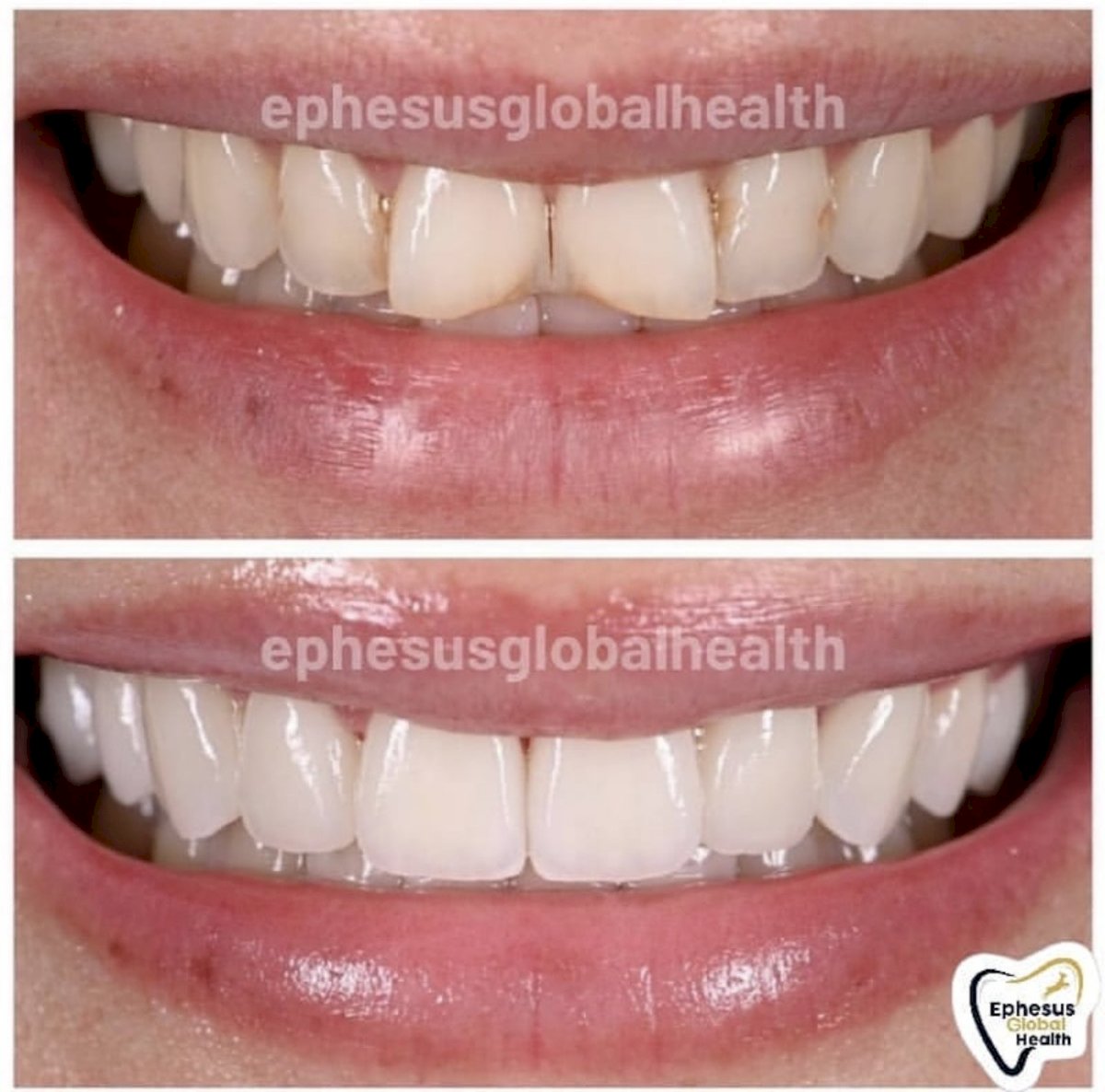 Couronnes Zircones — Ephesus global dental