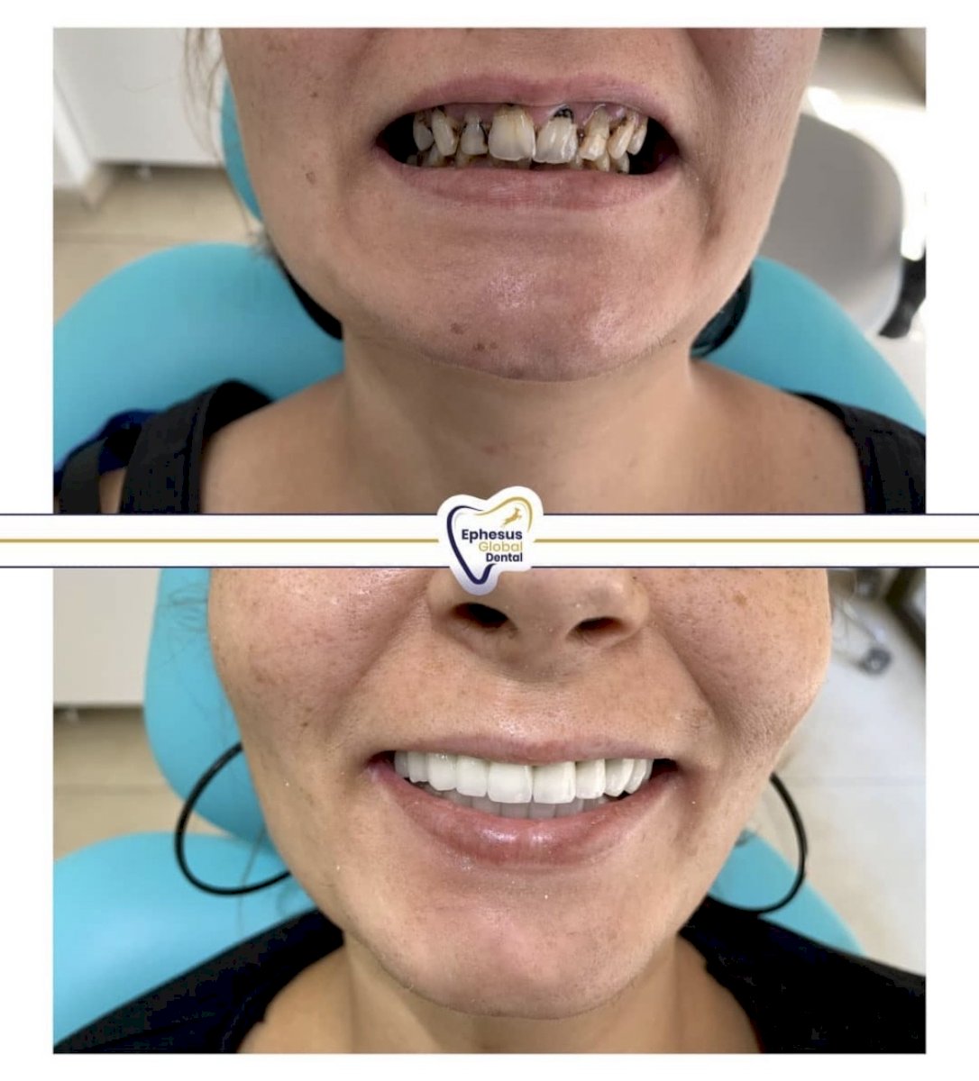 Couronnes Zircones — Ephesus global dental