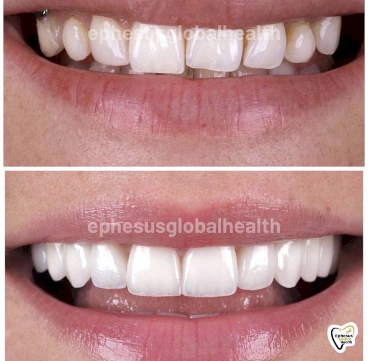 Couronnes Zircones — Ephesus global dental