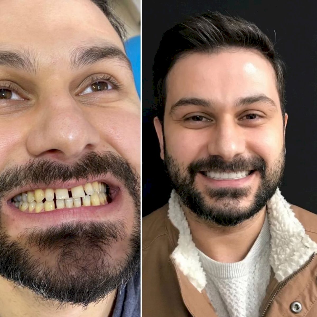 Couronnes Zircones — Ephesus global dental