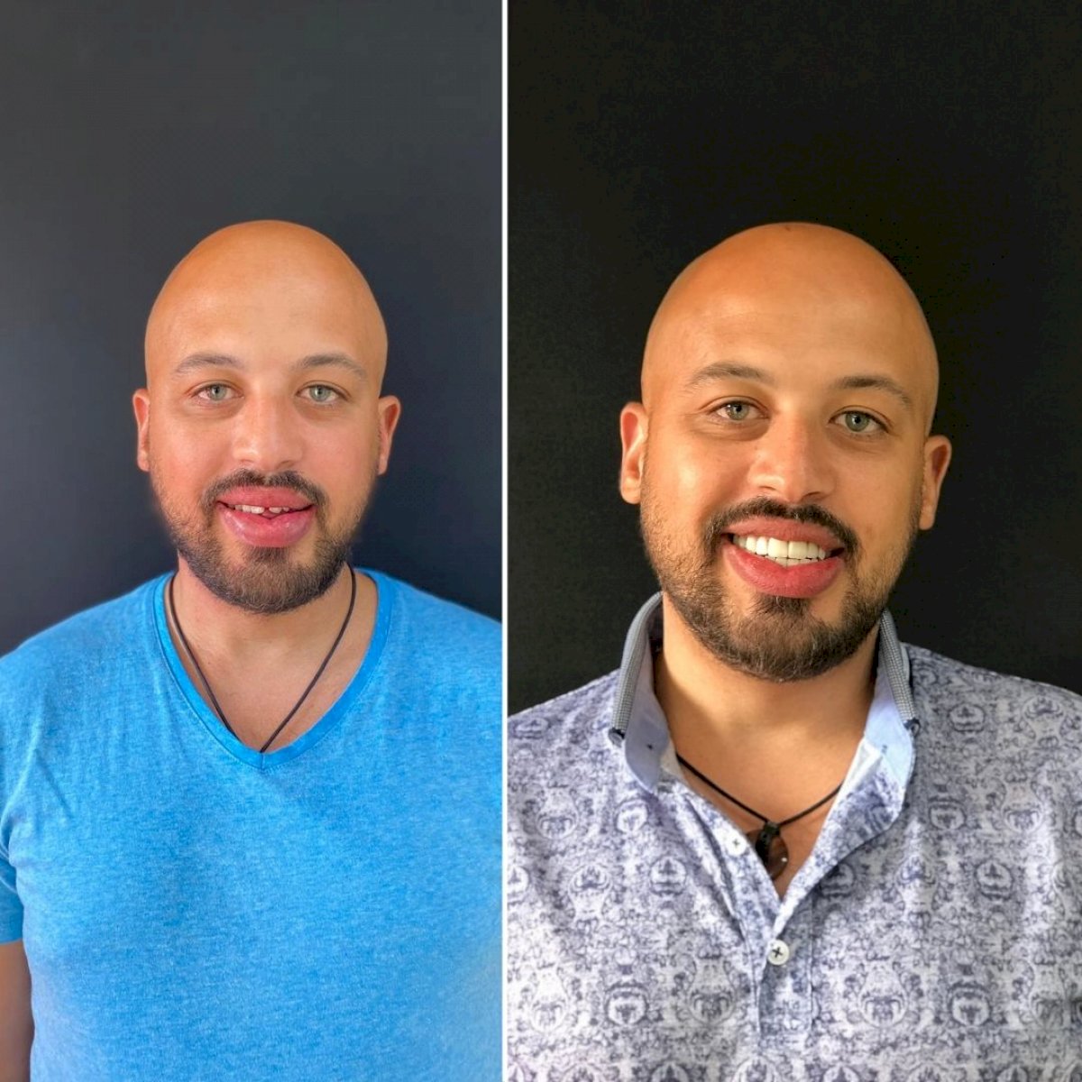 Couronnes Zircones — Ephesus global dental