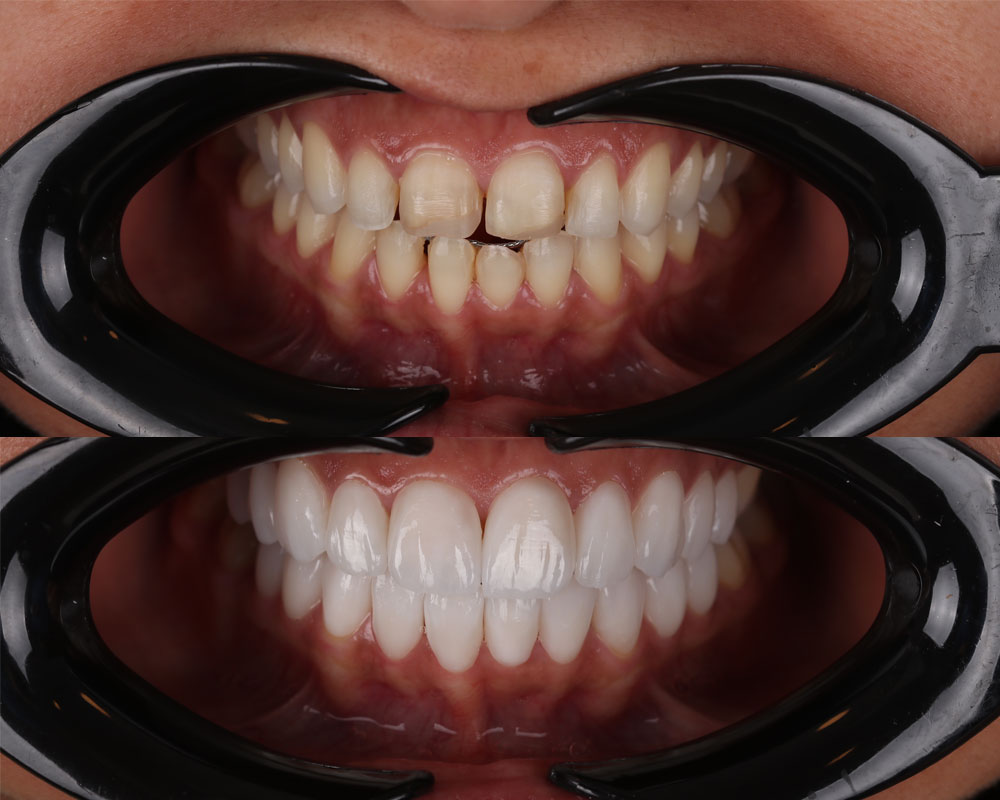 Facettes Dentaires — DXB Esthétique