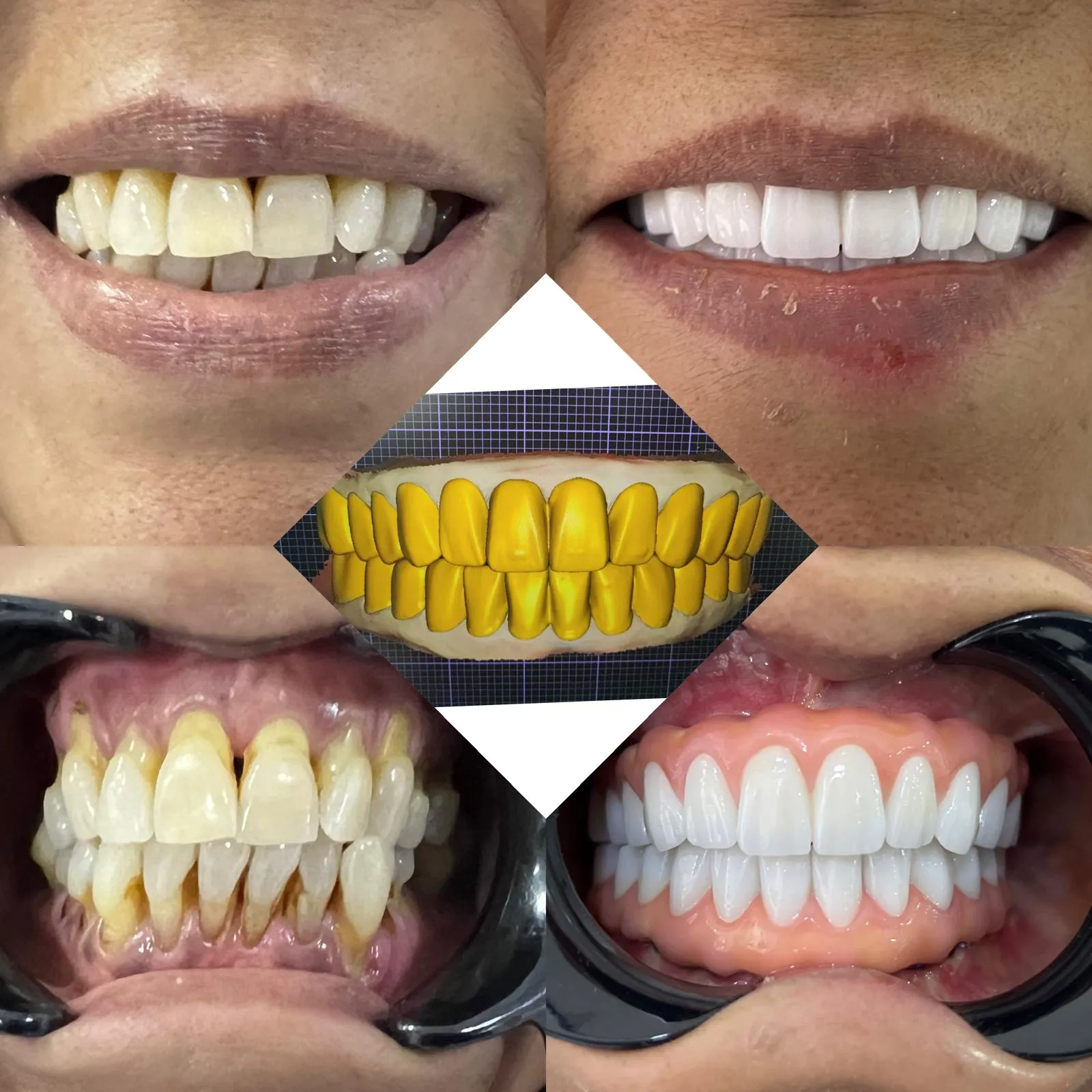 All-On-4 — Dentglow
