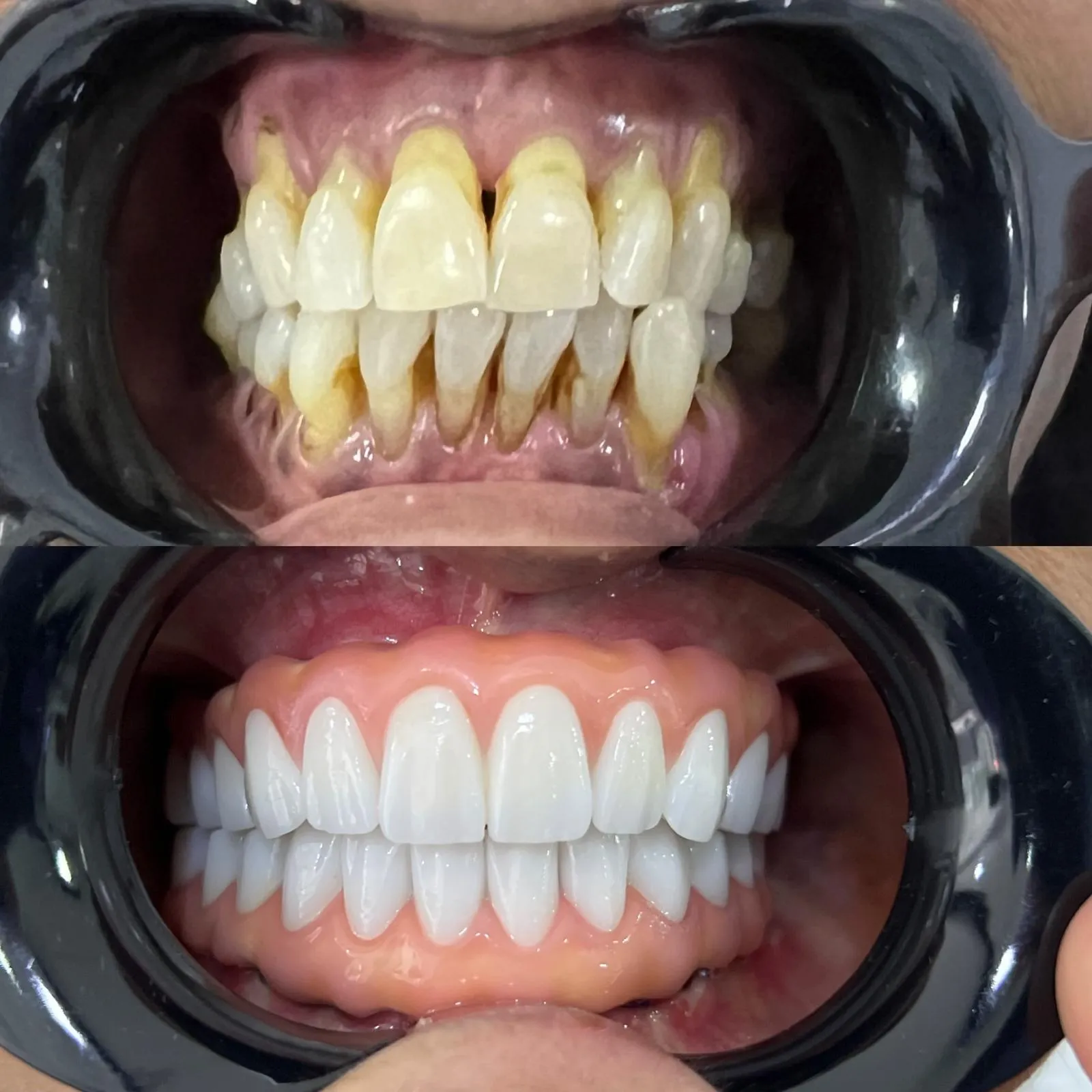 All-On-4 — Dentglow