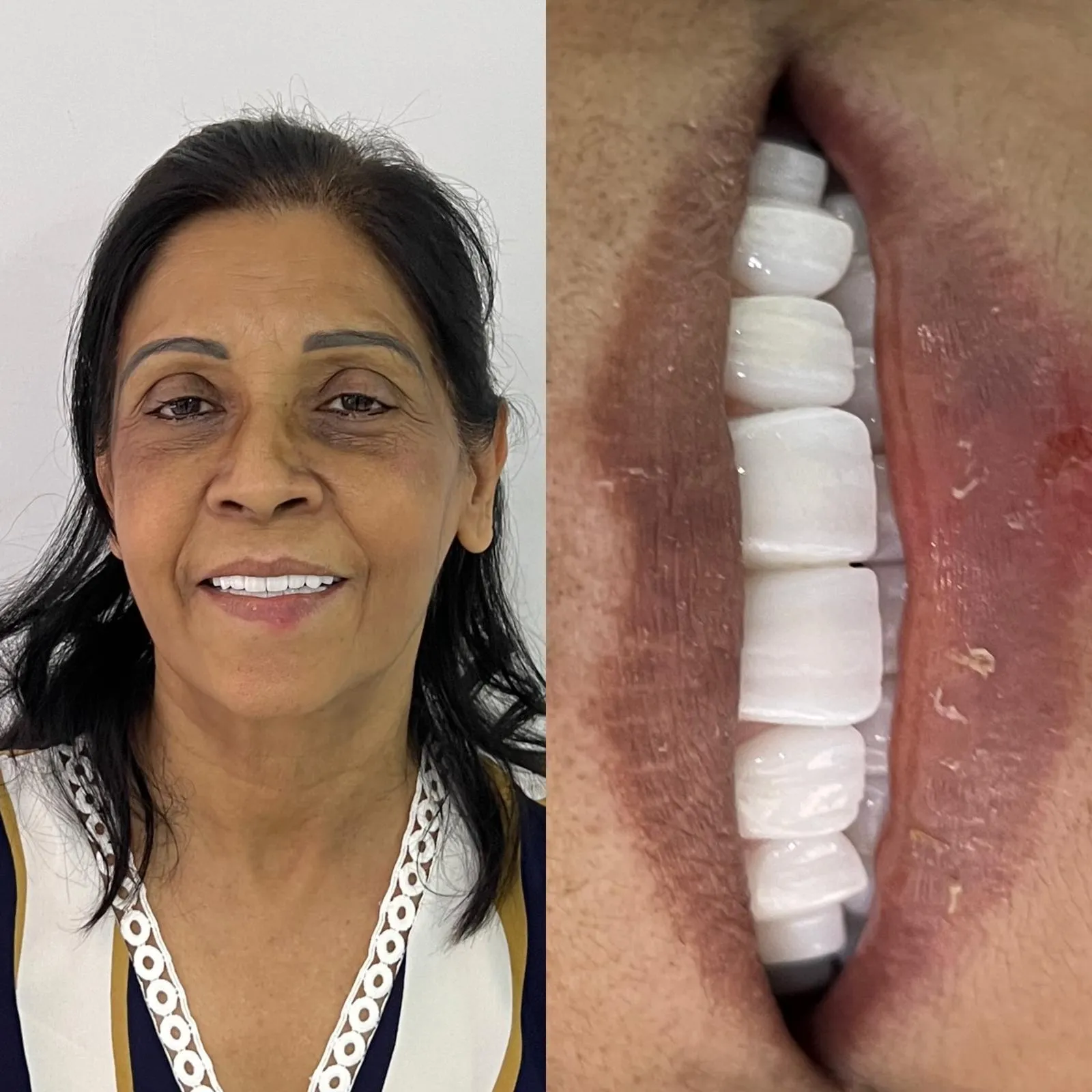 All-On-4 — Dentglow