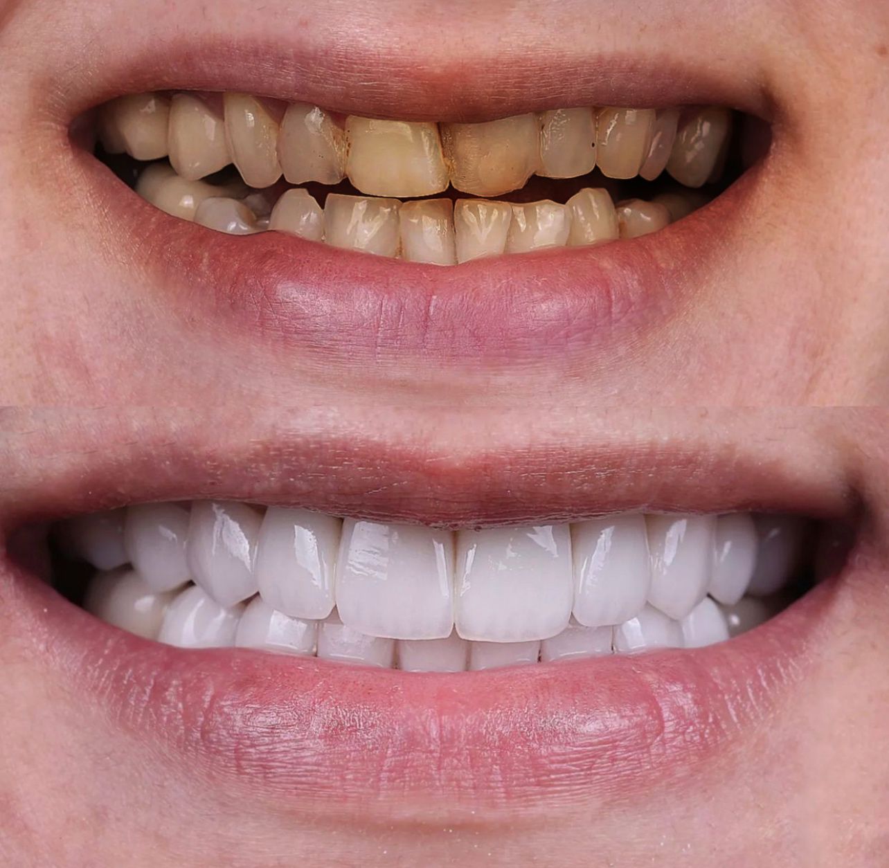 Facettes Dentaires — Dijital clinic