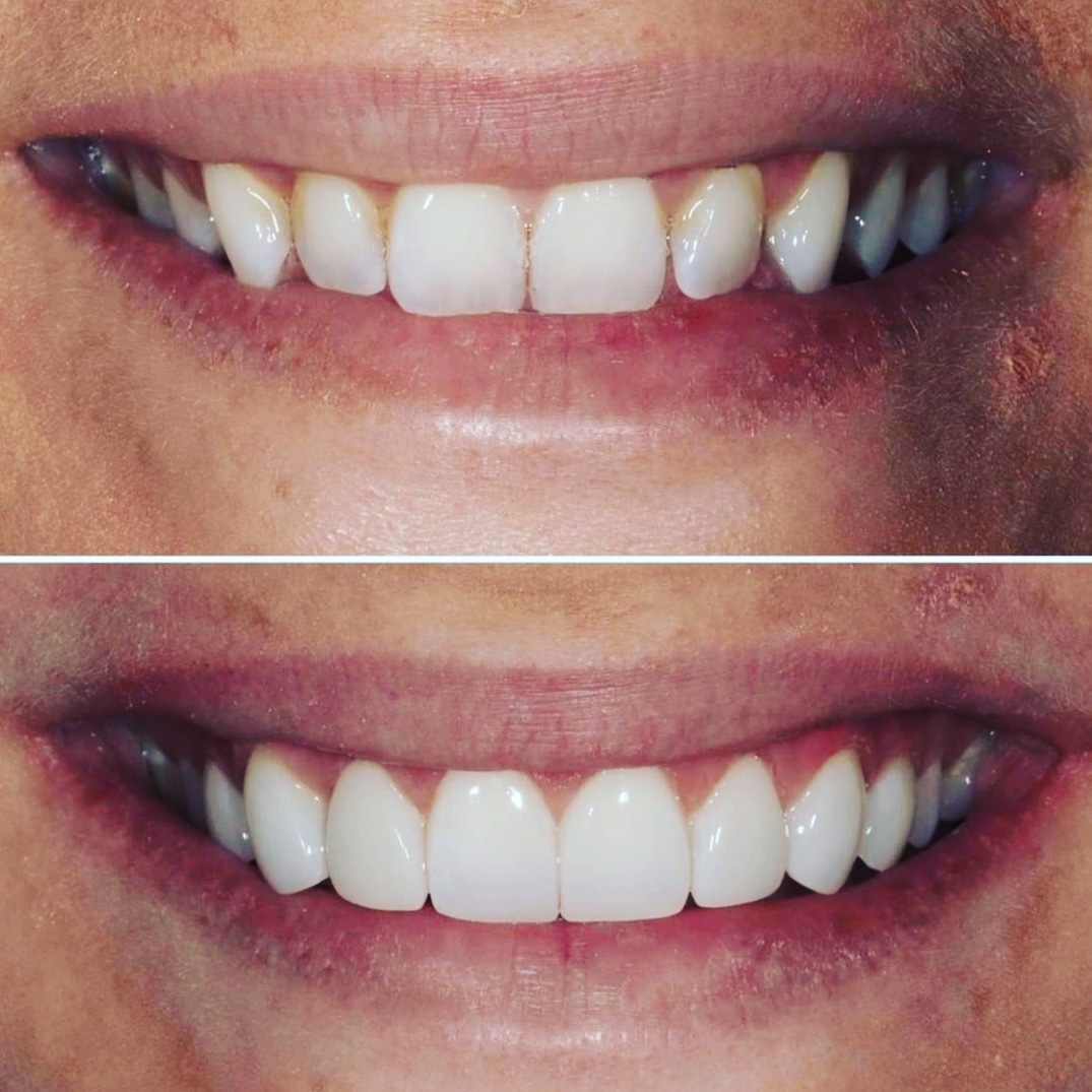 Facettes Dentaires — Dijital clinic