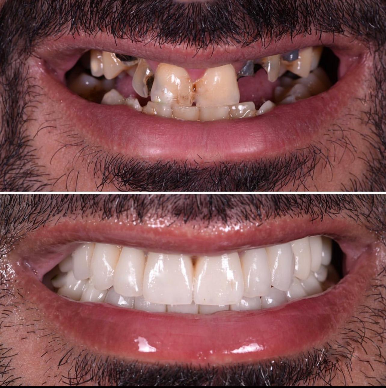 Facettes Dentaires — Dijital clinic