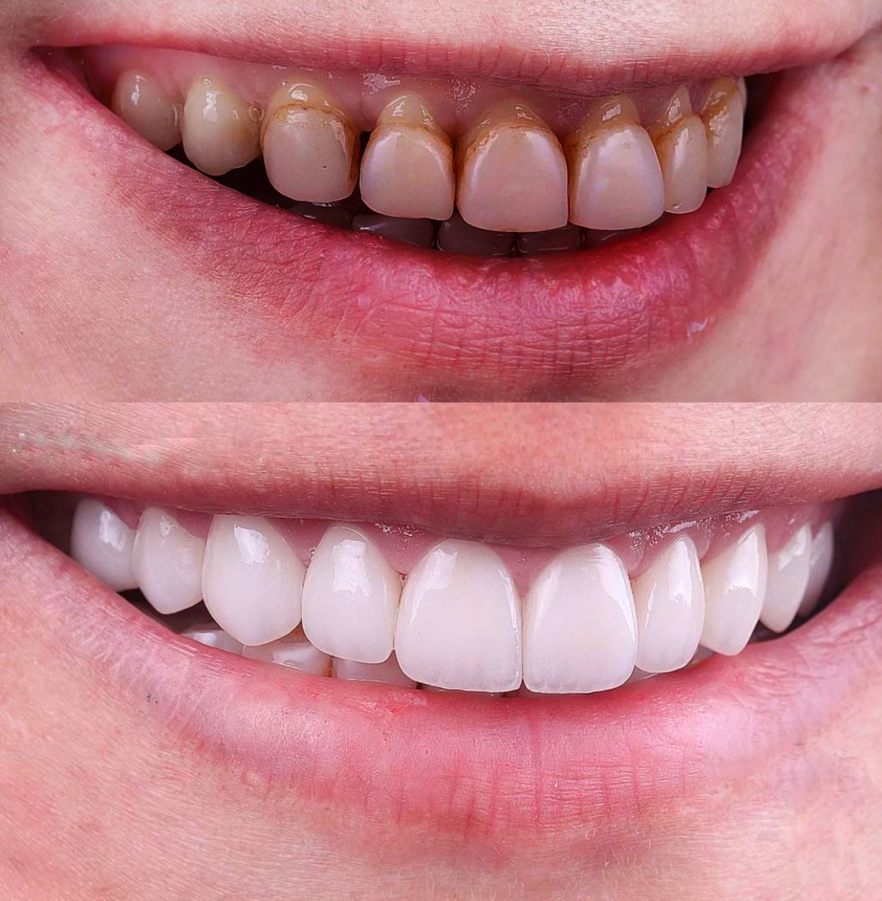 Corone dentali — Dijital clinic