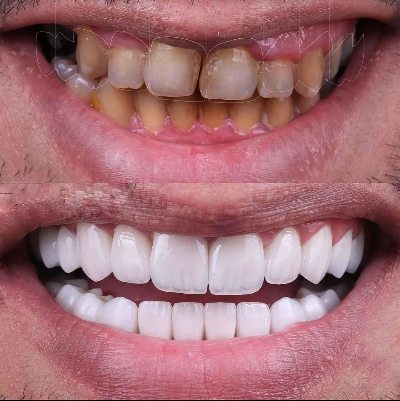 Corone dentali — Dijital clinic