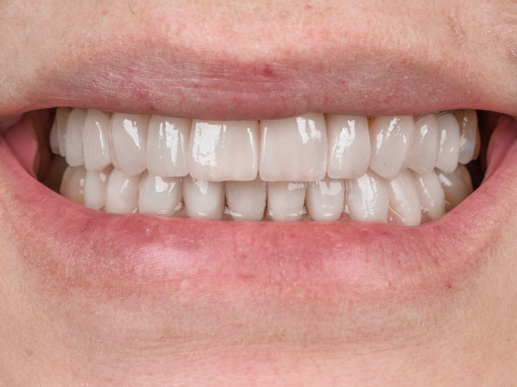Facettes Dentaires — VIP Smile