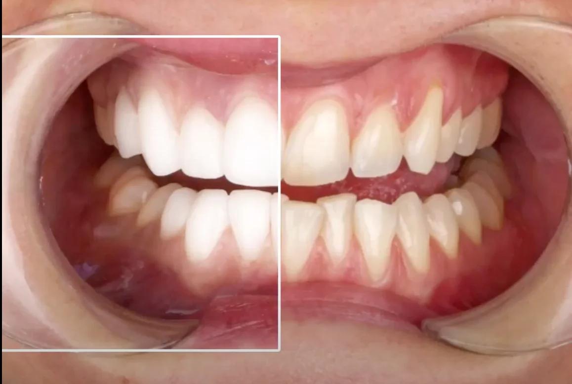 Facettes Emax — Dentaglobal