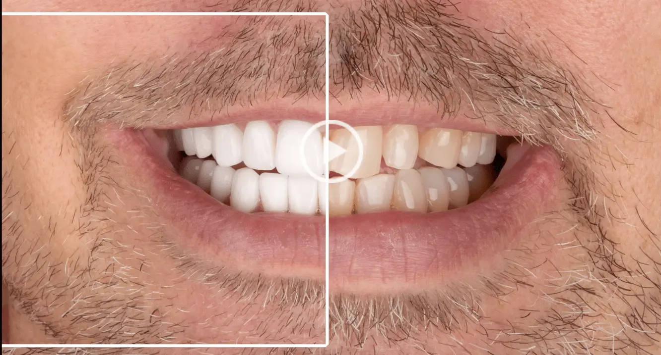 Facettes Emax — Dentaglobal