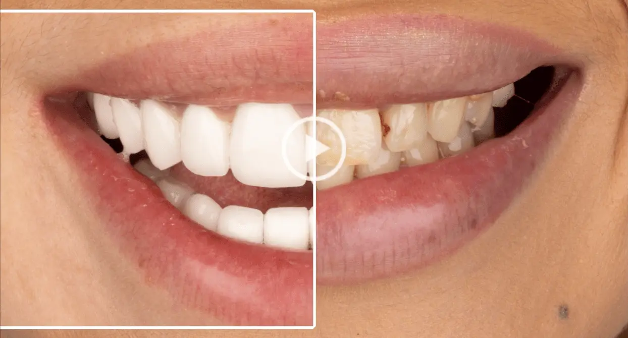 Facettes Emax — Dentaglobal