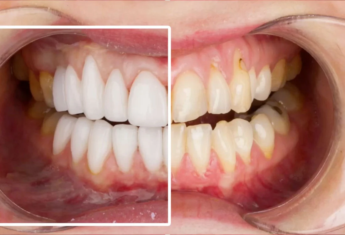 Facettes Emax — Dentaglobal