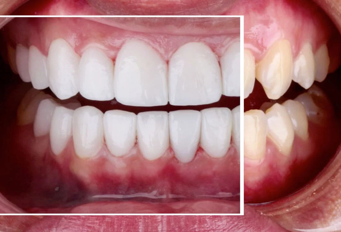Facettes Emax — Dentaglobal