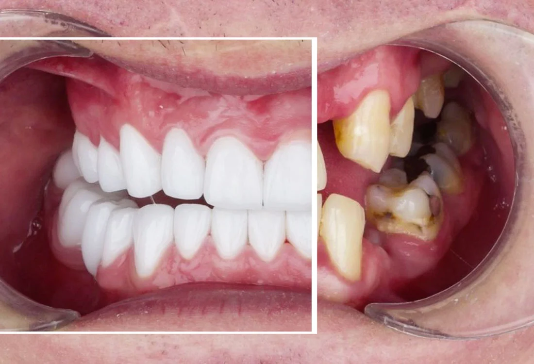 Facettes Emax — Dentaglobal