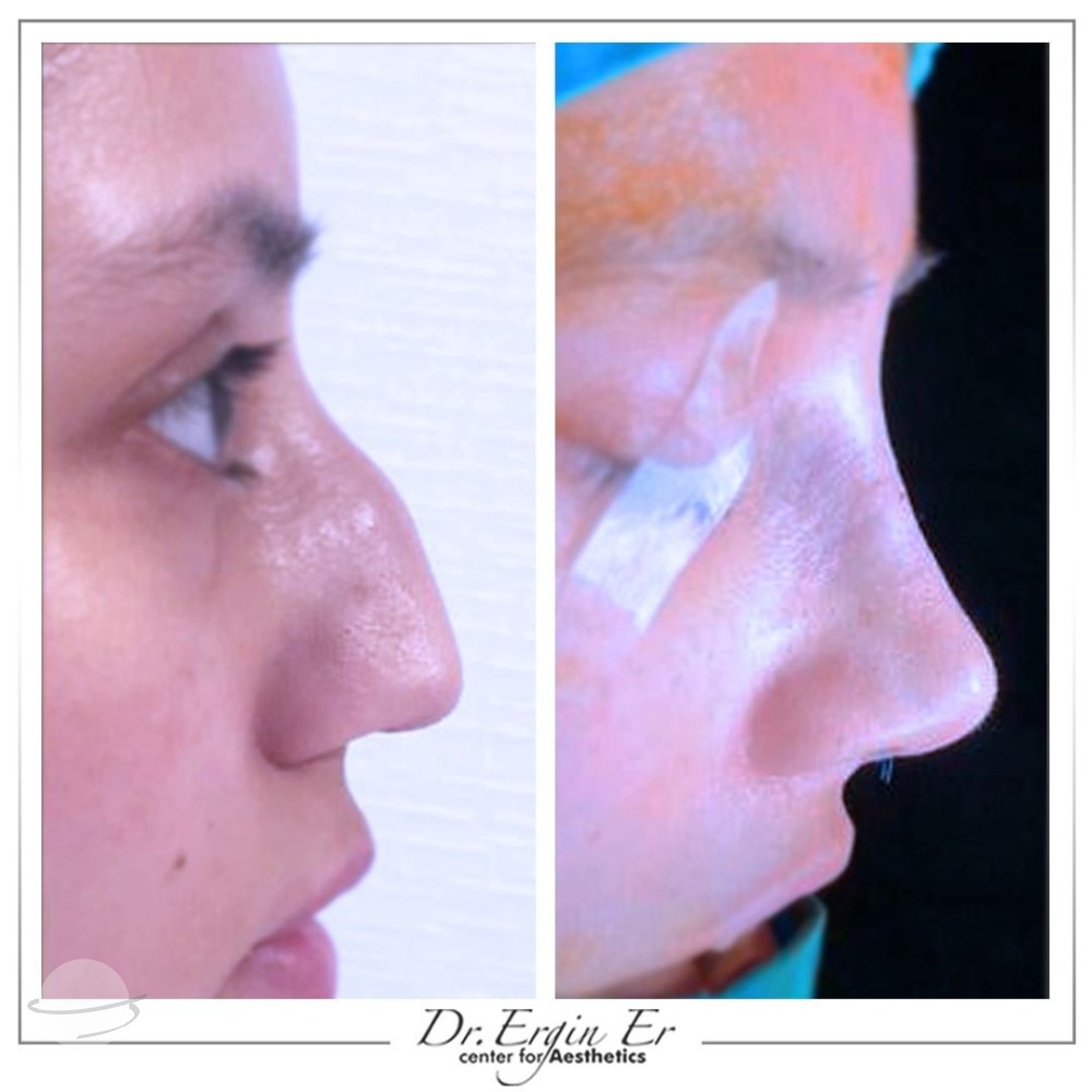 Rhinoplastie by Dr Ergin Er