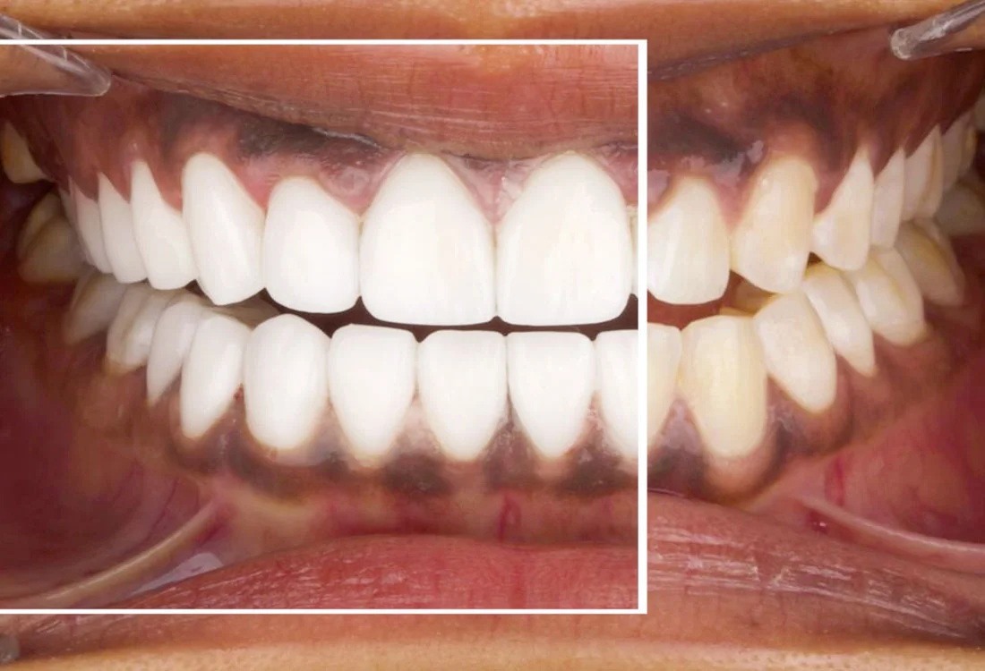 Facettes Emax — Dentaglobal