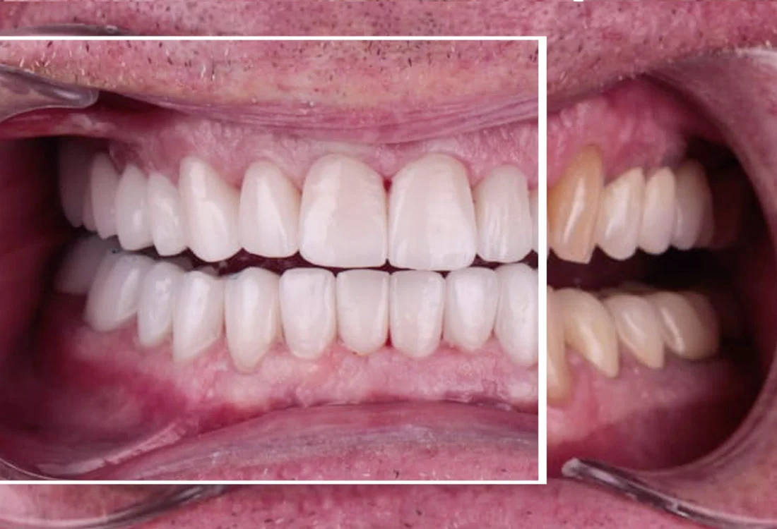 Facettes Emax — Dentaglobal