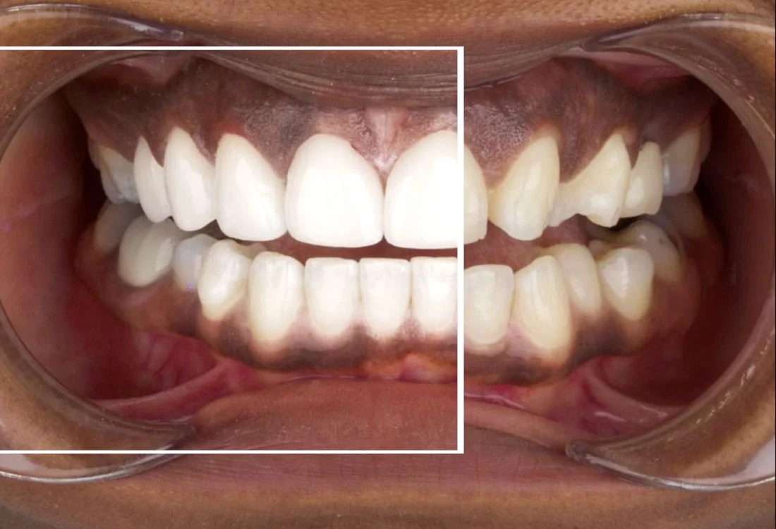 Facettes Emax — Dentaglobal