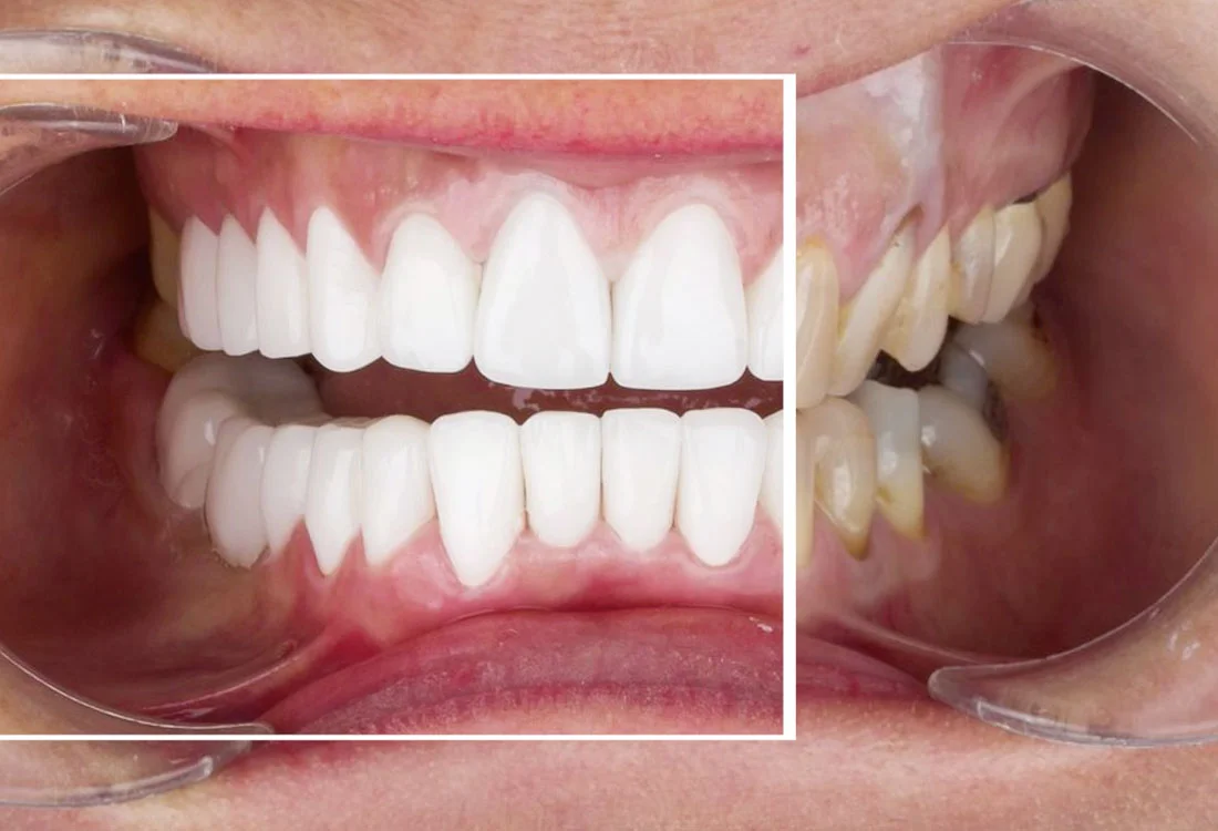 Facettes Emax — Dentaglobal
