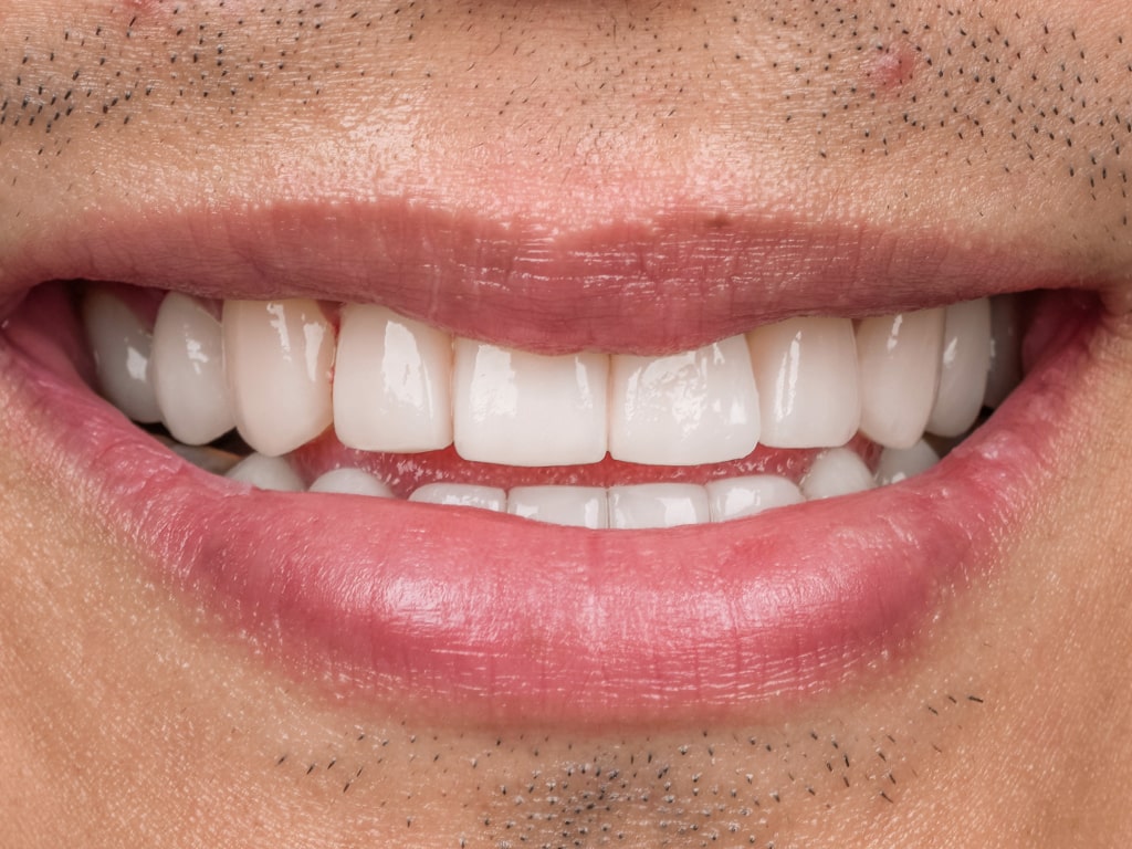 Couronnes Dentaires — VIP Smile