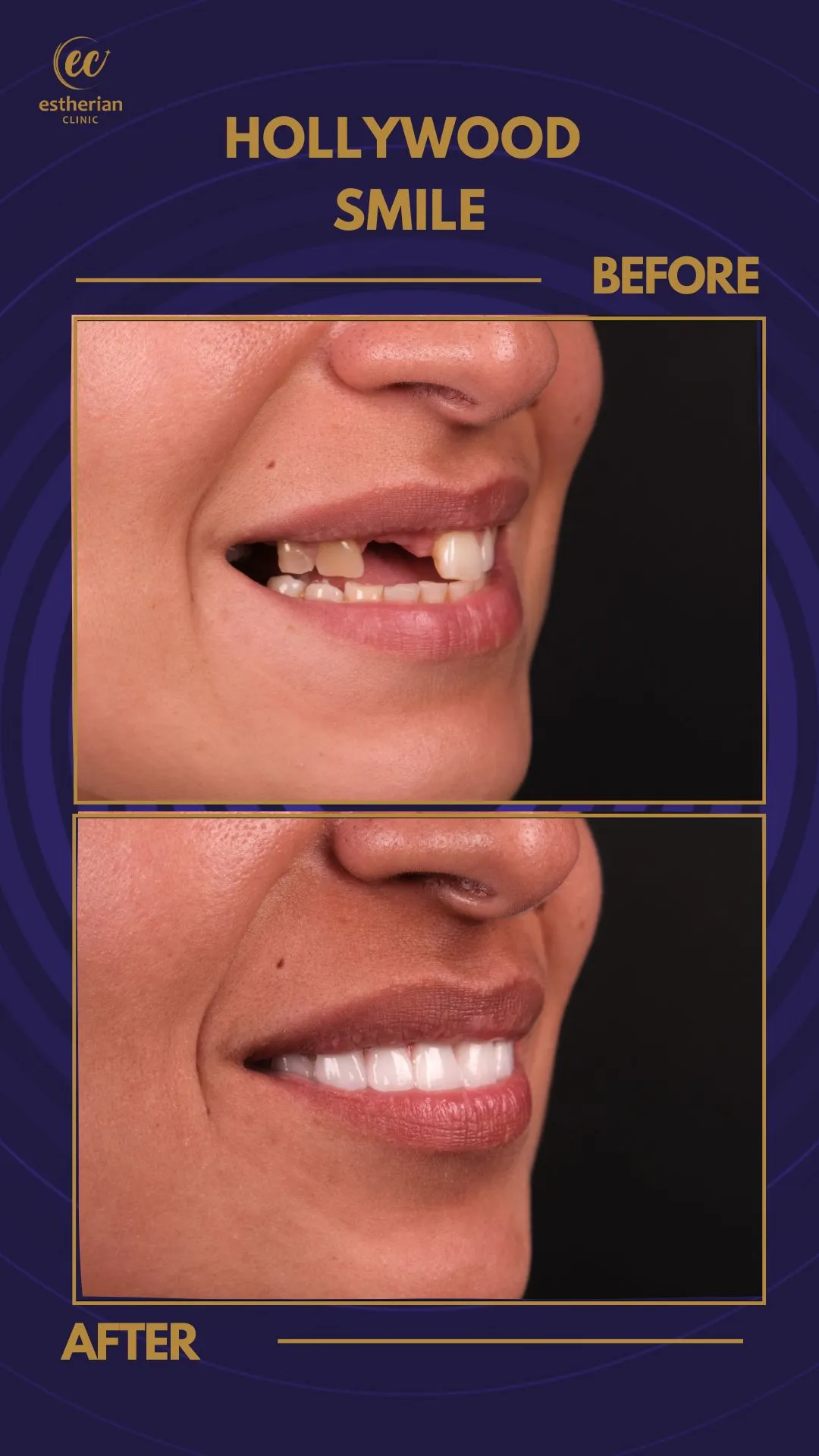 Corone dentali — Estherian clinic