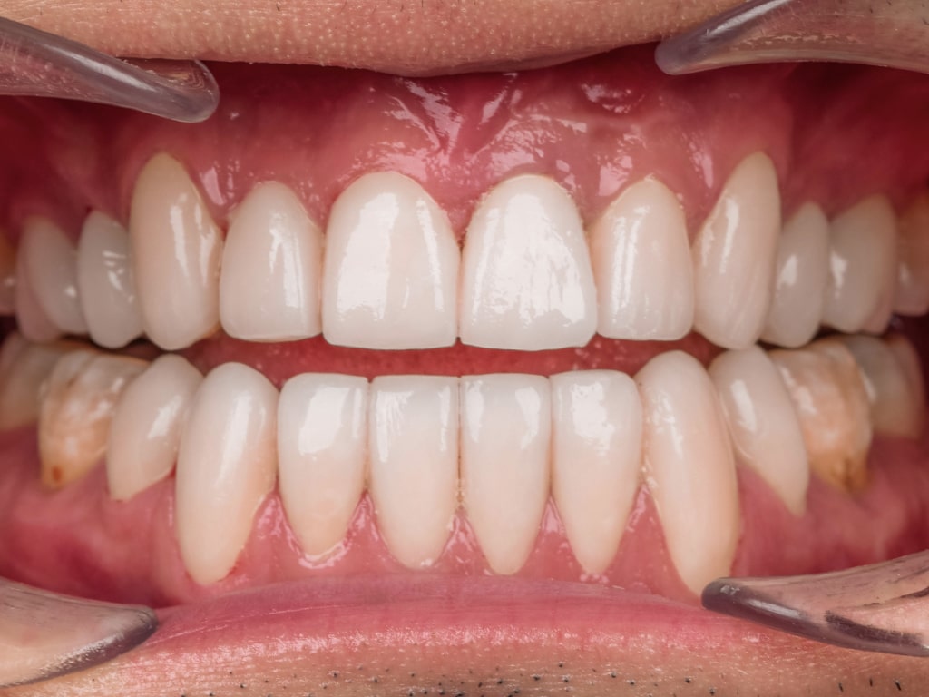Couronnes Dentaires — VIP Smile