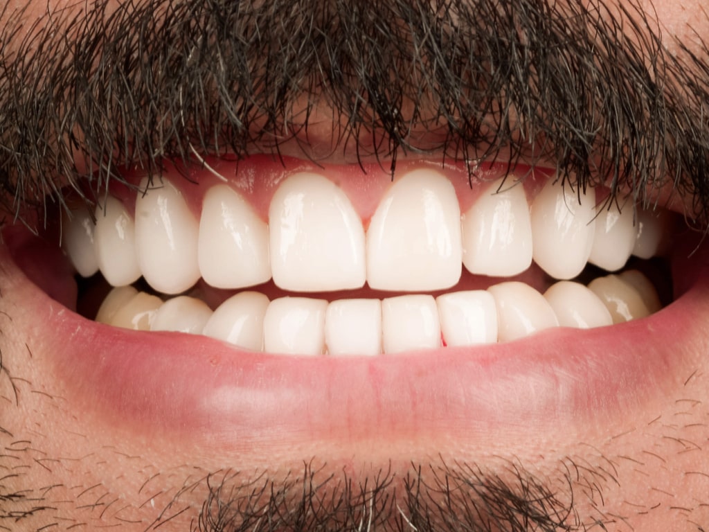 Couronnes Dentaires — VIP Smile