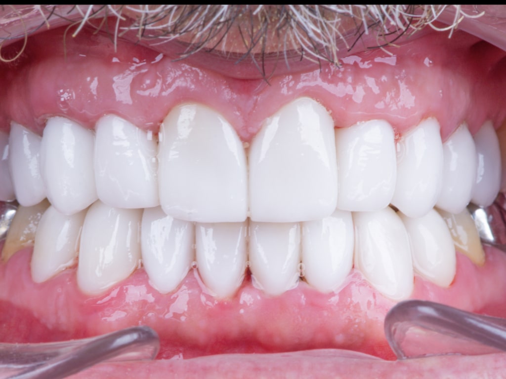 Couronnes Dentaires — VIP Smile