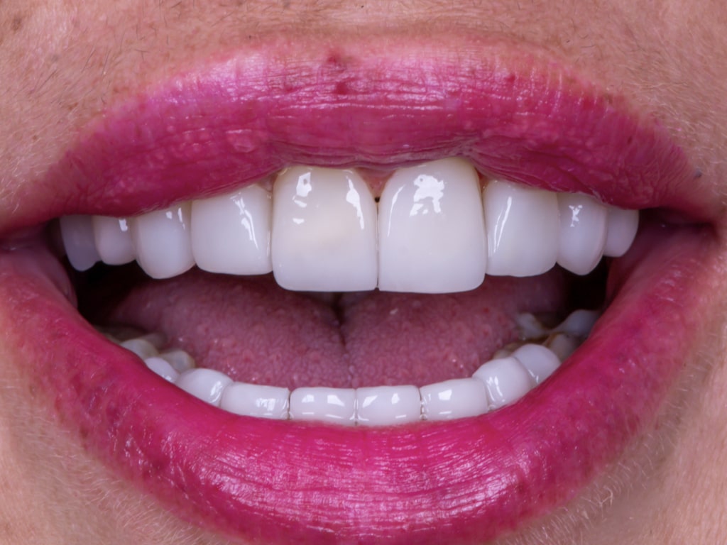 Couronnes Dentaires — VIP Smile
