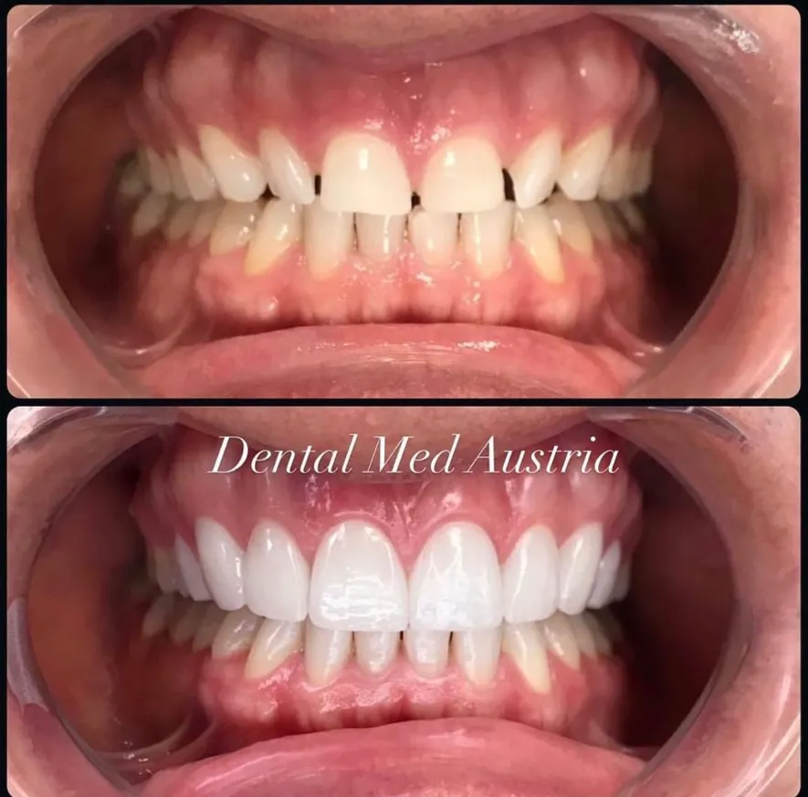 Couronnes Dentaires — Dental Med Austria