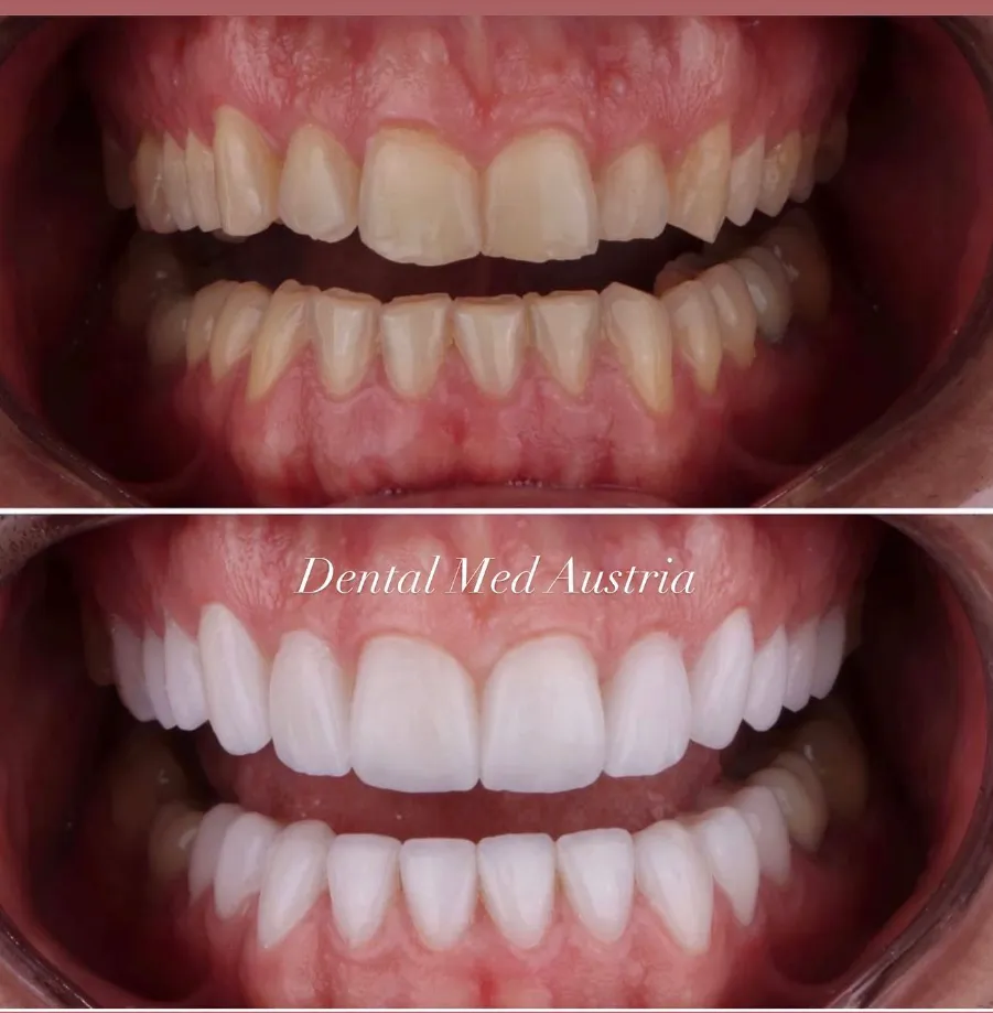 Couronnes Dentaires — Dental Med Austria