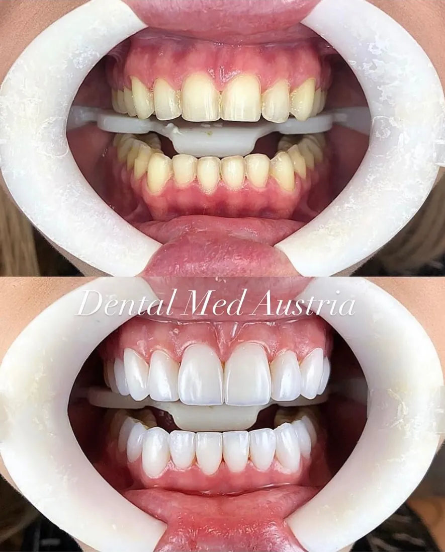 Couronnes Dentaires — Dental Med Austria
