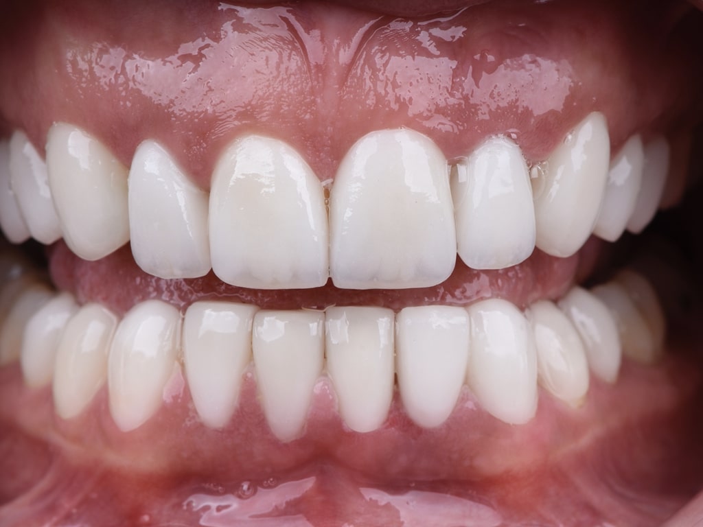 Couronnes Dentaires — VIP Smile