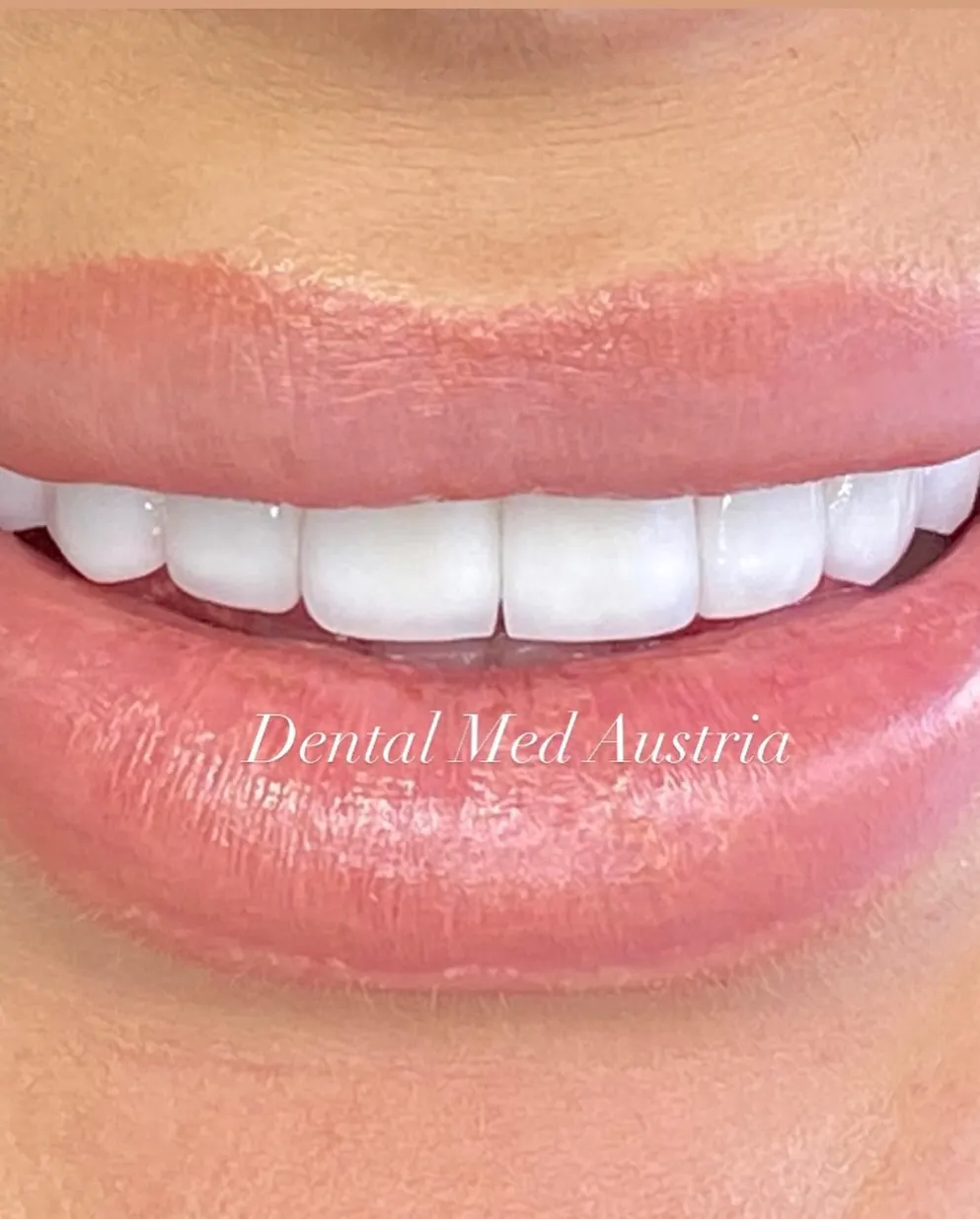 Couronnes Dentaires — Dental Med Austria
