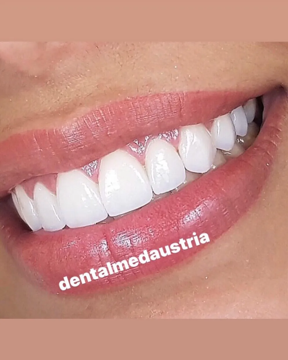 Couronnes Dentaires — Dental Med Austria